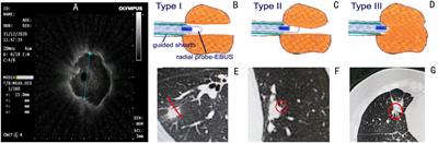Predictive value of the resistance of the probe to pass through the lesion in the diagnosis of peripheral pulmonary lesions using radial probe endobronchial ultrasound with a guide sheath
